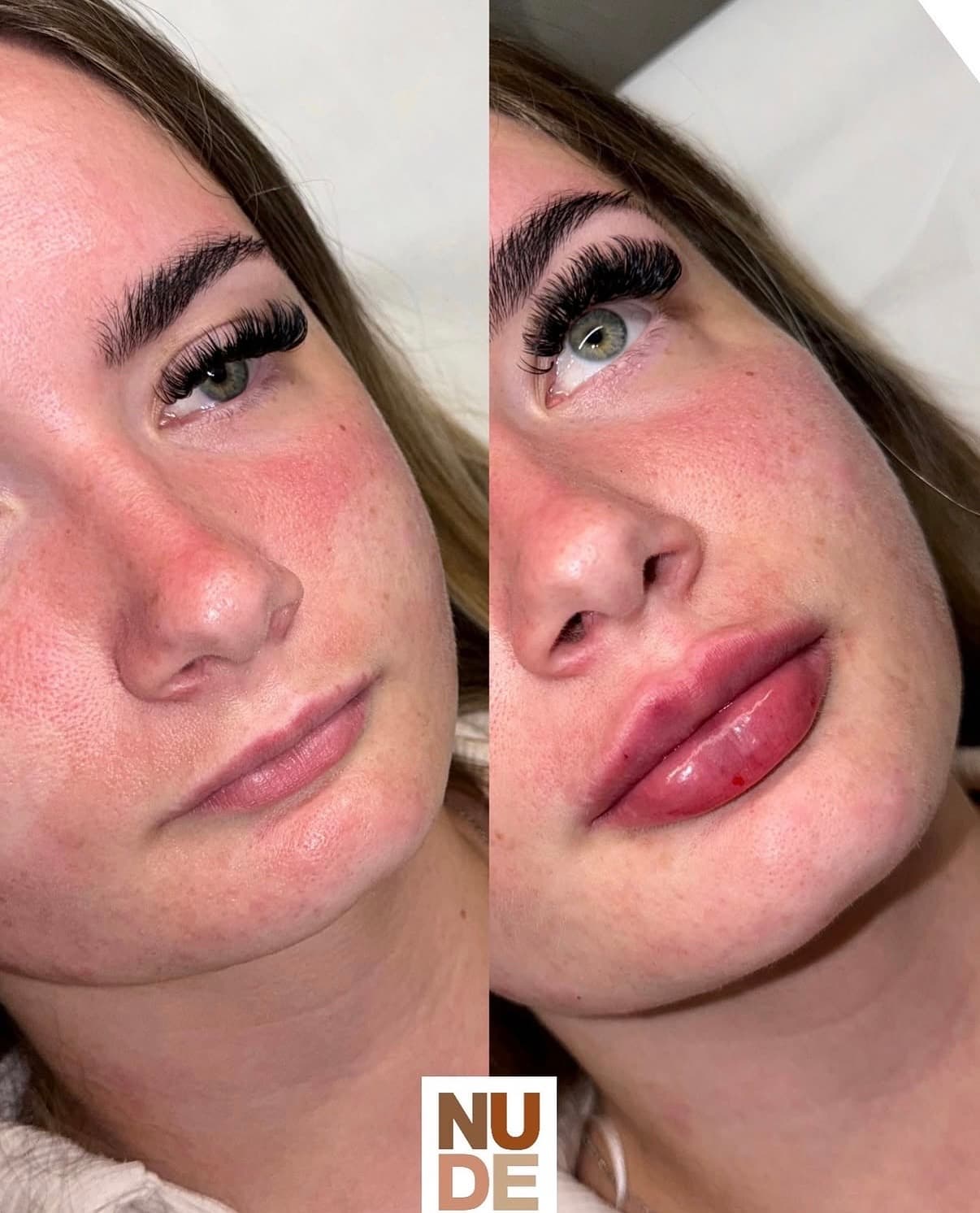 Lip enhancement before and after
